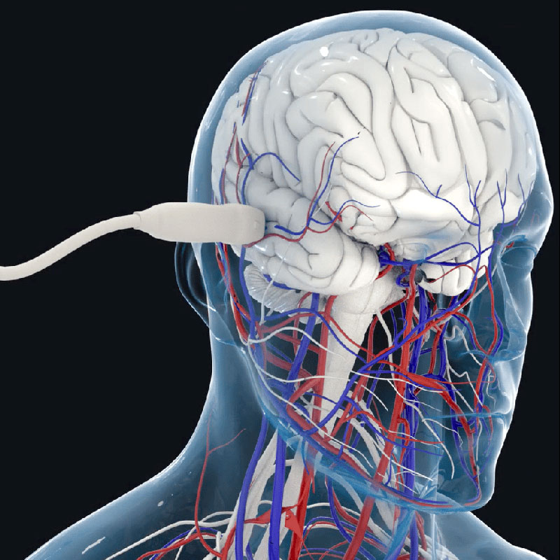 Transcranial imaging of the brain microvasculature in adults (artist’s impression). Courtesy A. Dizeux/M. Tanter. Iconeus